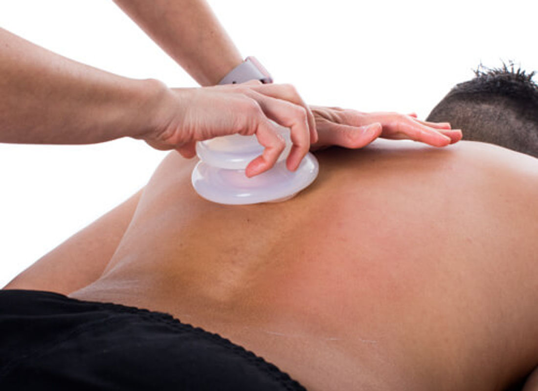 Cupping therapy in progress, silicone cups applied to the back.